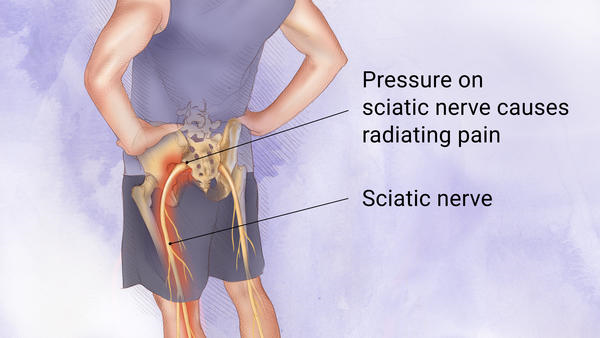 Sciatica Pain: Who can be affected